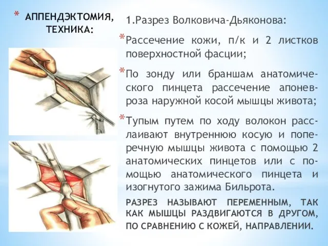 АППЕНДЭКТОМИЯ, ТЕХНИКА: 1.Разрез Волковича-Дьяконова: Рассечение кожи, п/к и 2 листков поверхностной фасции;