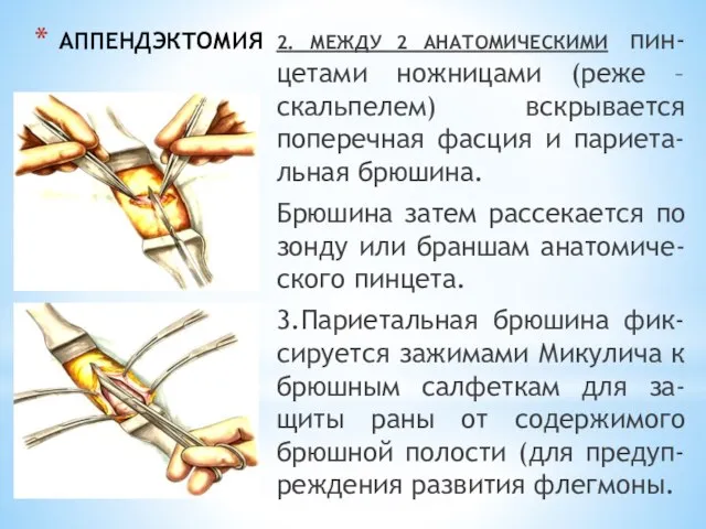 АППЕНДЭКТОМИЯ 2. МЕЖДУ 2 АНАТОМИЧЕСКИМИ пин-цетами ножницами (реже – скальпелем) вскрывается поперечная