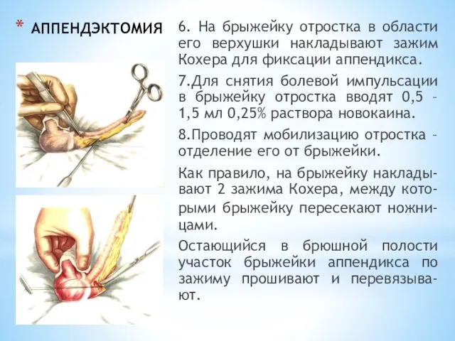 АППЕНДЭКТОМИЯ 6. На брыжейку отростка в области его верхушки накладывают зажим Кохера