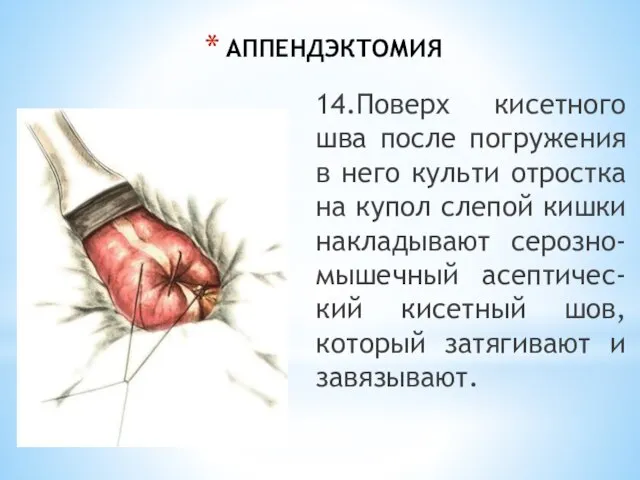 АППЕНДЭКТОМИЯ 14.Поверх кисетного шва после погружения в него культи отростка на купол