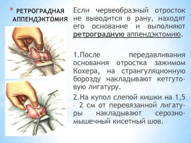 РЕТРОГРАДНАЯ АППЕНДЭКТОМИЯ Если червеобразный отросток не выводится в рану, находят его основание