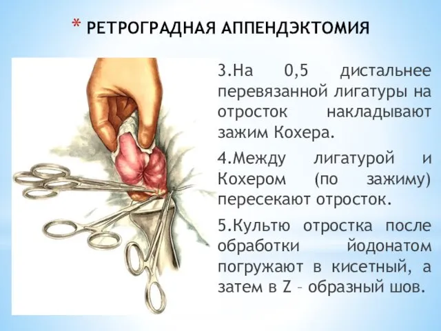 РЕТРОГРАДНАЯ АППЕНДЭКТОМИЯ 3.На 0,5 дистальнее перевязанной лигатуры на отросток накладывают зажим Кохера.