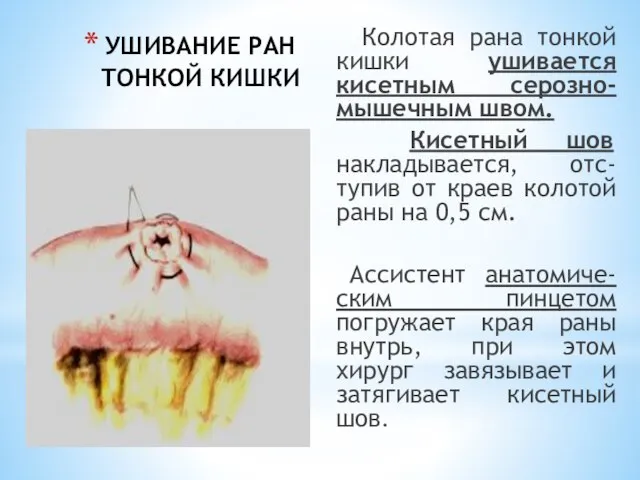 УШИВАНИЕ РАН ТОНКОЙ КИШКИ Колотая рана тонкой кишки ушивается кисетным серозно-мышечным швом.