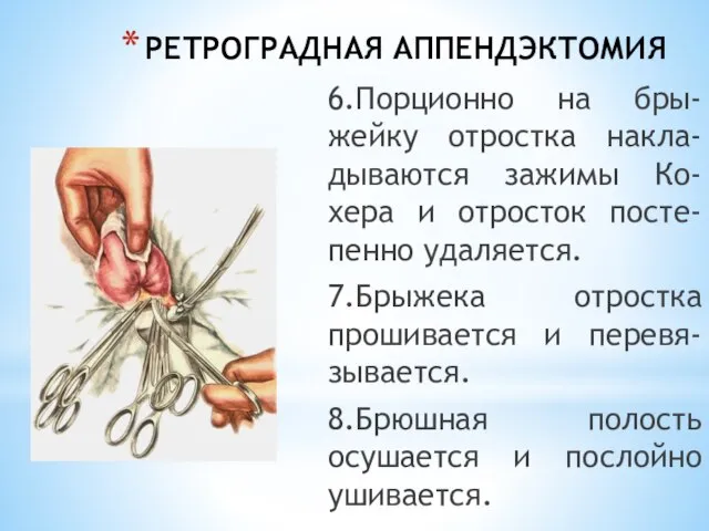 РЕТРОГРАДНАЯ АППЕНДЭКТОМИЯ 6.Порционно на бры-жейку отростка накла-дываются зажимы Ко-хера и отросток посте-пенно