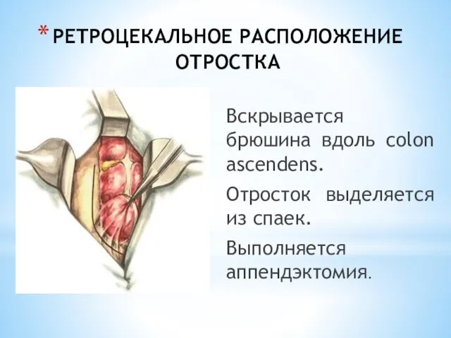 РЕТРОЦЕКАЛЬНОЕ РАСПОЛОЖЕНИЕ ОТРОСТКА Вскрывается брюшина вдоль colon ascendens. Отросток выделяется из спаек. Выполняется аппендэктомия.