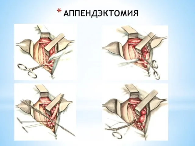 АППЕНДЭКТОМИЯ