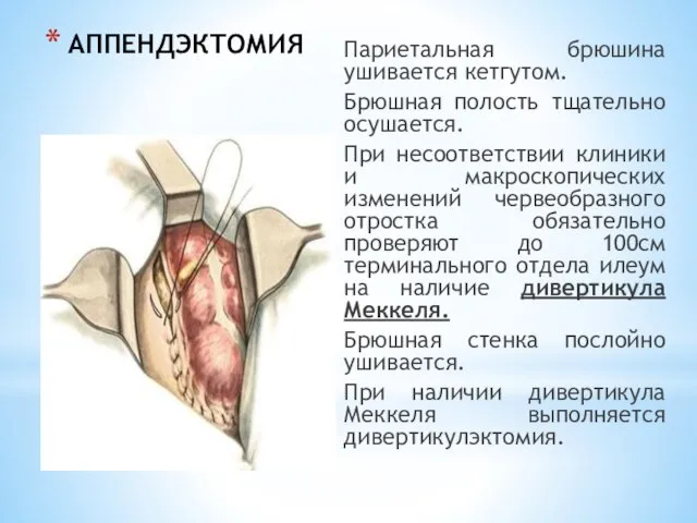 АППЕНДЭКТОМИЯ Париетальная брюшина ушивается кетгутом. Брюшная полость тщательно осушается. При несоответствии клиники