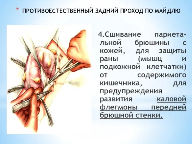 ПРОТИВОЕСТЕСТВЕННЫЙ ЗАДНИЙ ПРОХОД ПО МАЙДЛЮ 4.Сшивание париета-льной брюшины с кожей, для защиты