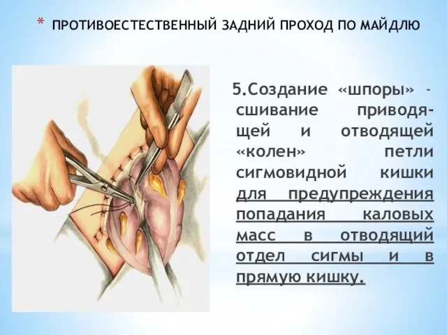 ПРОТИВОЕСТЕСТВЕННЫЙ ЗАДНИЙ ПРОХОД ПО МАЙДЛЮ 5.Создание «шпоры» - сшивание приводя-щей и отводящей