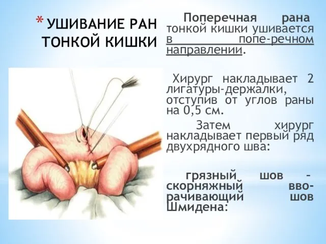 УШИВАНИЕ РАН ТОНКОЙ КИШКИ Поперечная рана тонкой кишки ушивается в попе-речном направлении.