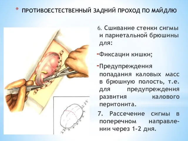 ПРОТИВОЕСТЕСТВЕННЫЙ ЗАДНИЙ ПРОХОД ПО МАЙДЛЮ 6. Сшивание стенки сигмы и париетальной брюшины