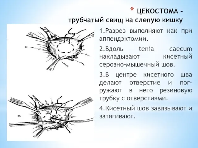 ЦЕКОСТОМА – трубчатый свищ на слепую кишку 1.Разрез выполняют как при аппендэктомии.