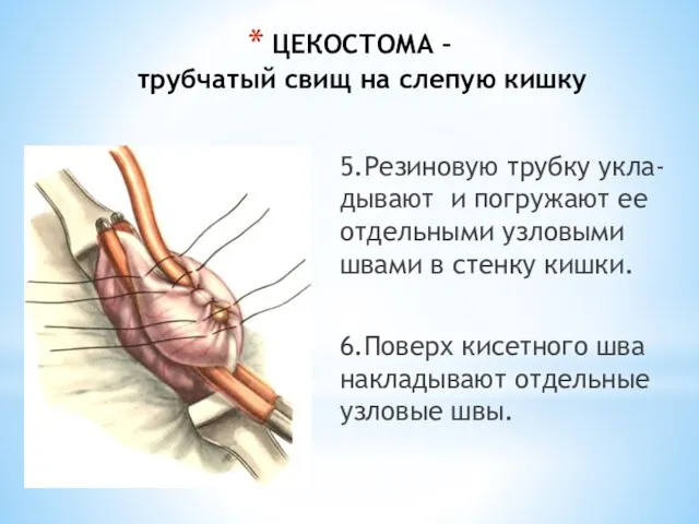 ЦЕКОСТОМА – трубчатый свищ на слепую кишку 5.Резиновую трубку укла-дывают и погружают