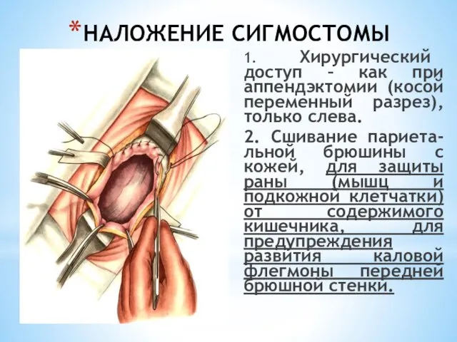 НАЛОЖЕНИЕ СИГМОСТОМЫ 1. Хирургический доступ – как при аппендэктомии (косой переменный разрез),