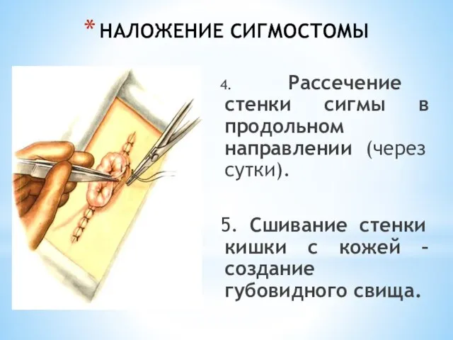 НАЛОЖЕНИЕ СИГМОСТОМЫ 4. Рассечение стенки сигмы в продольном направлении (через сутки). 5.