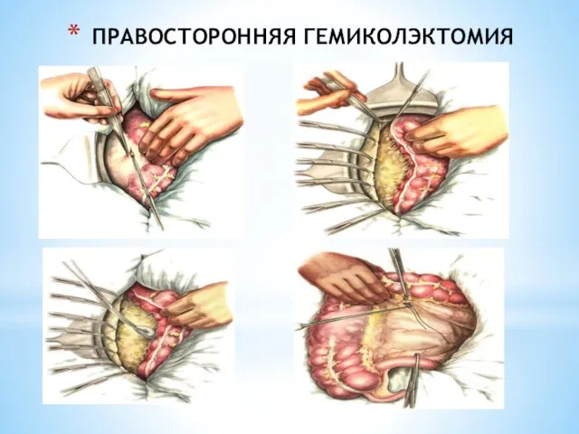 ПРАВОСТОРОННЯЯ ГЕМИКОЛЭКТОМИЯ