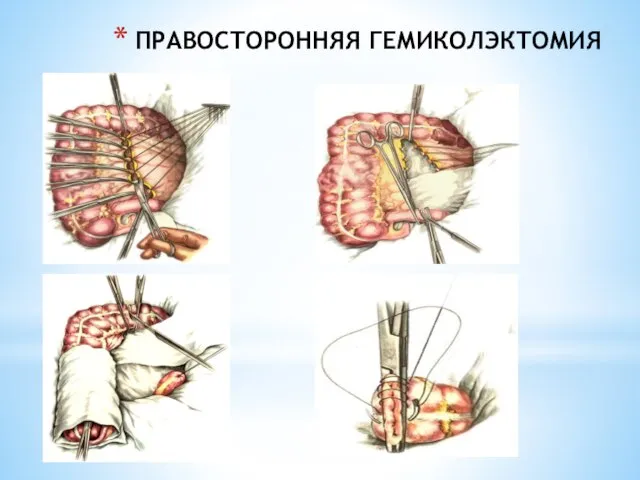 ПРАВОСТОРОННЯЯ ГЕМИКОЛЭКТОМИЯ