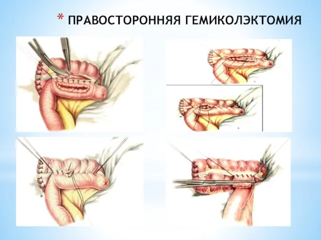 ПРАВОСТОРОННЯЯ ГЕМИКОЛЭКТОМИЯ