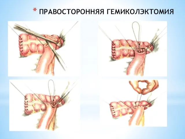 ПРАВОСТОРОННЯЯ ГЕМИКОЛЭКТОМИЯ