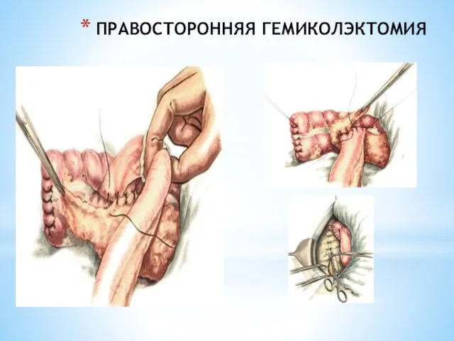 ПРАВОСТОРОННЯЯ ГЕМИКОЛЭКТОМИЯ