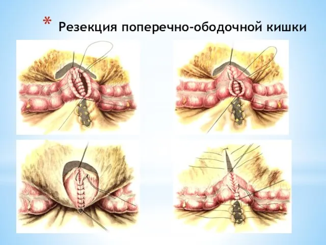 Резекция поперечно-ободочной кишки