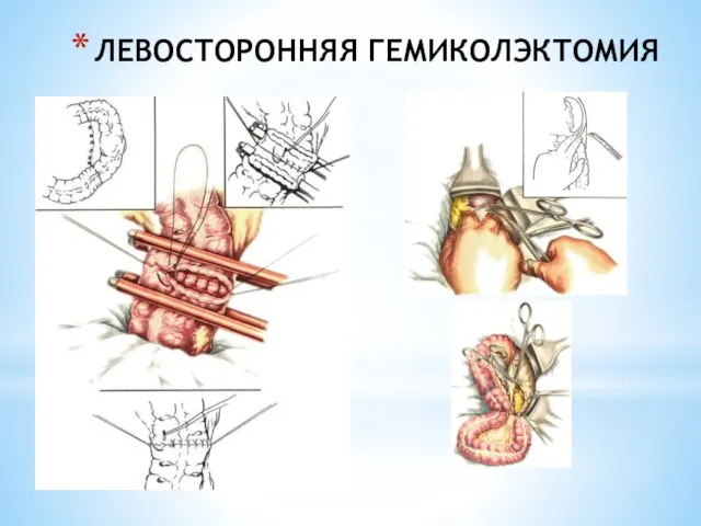 ЛЕВОСТОРОННЯЯ ГЕМИКОЛЭКТОМИЯ