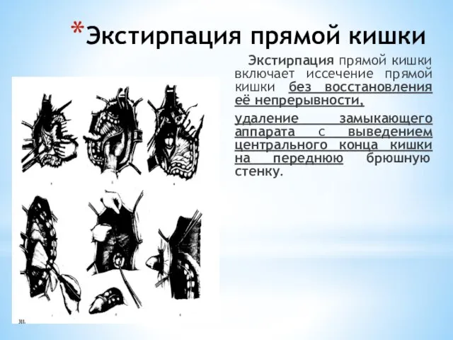 Экстирпация прямой кишки Экстирпация прямой кишки включает иссечение прямой кишки без восстановления