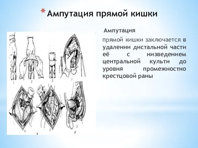 Ампутация прямой кишки Ампутация прямой кишки заключается в удалении дистальной части её