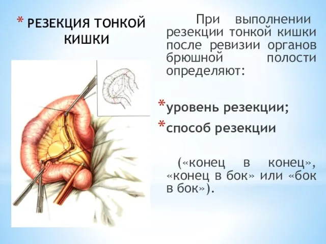 РЕЗЕКЦИЯ ТОНКОЙ КИШКИ При выполнении резекции тонкой кишки после ревизии органов брюшной