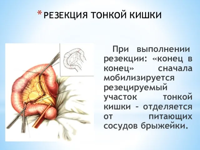 РЕЗЕКЦИЯ ТОНКОЙ КИШКИ При выполнении резекции: «конец в конец» сначала мобилизируется резецируемый