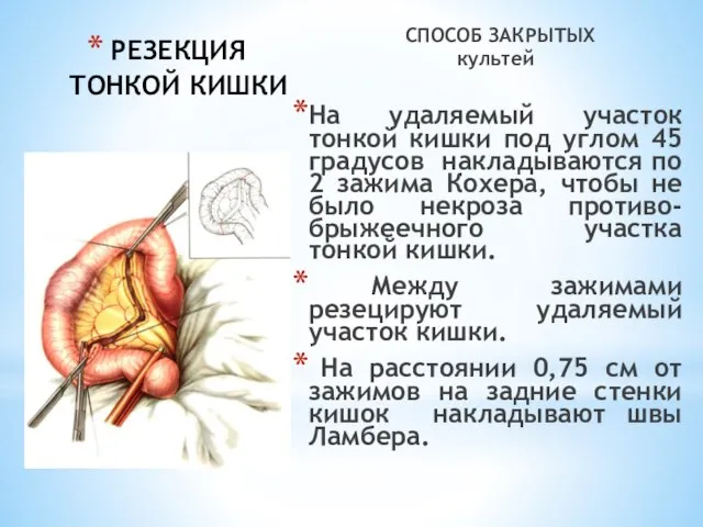 РЕЗЕКЦИЯ ТОНКОЙ КИШКИ СПОСОБ ЗАКРЫТЫХ культей На удаляемый участок тонкой кишки под