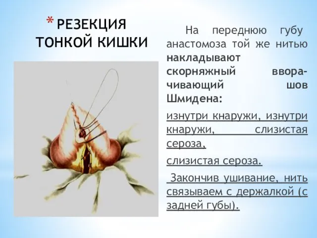 РЕЗЕКЦИЯ ТОНКОЙ КИШКИ На переднюю губу анастомоза той же нитью накладывают скорняжный