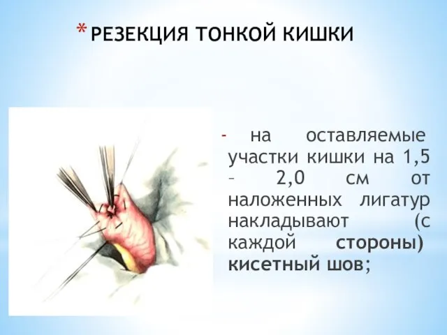 РЕЗЕКЦИЯ ТОНКОЙ КИШКИ на оставляемые участки кишки на 1,5 – 2,0 см