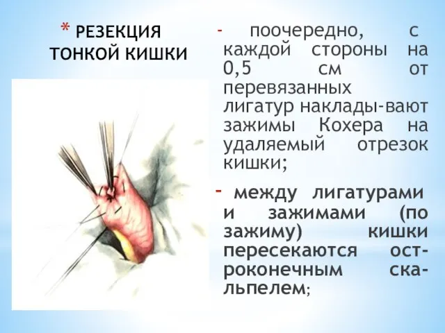 РЕЗЕКЦИЯ ТОНКОЙ КИШКИ поочередно, с каждой стороны на 0,5 см от перевязанных