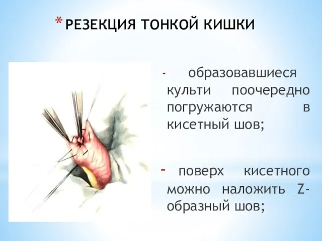 РЕЗЕКЦИЯ ТОНКОЙ КИШКИ образовавшиеся культи поочередно погружаются в кисетный шов; поверх кисетного можно наложить Z-образный шов;