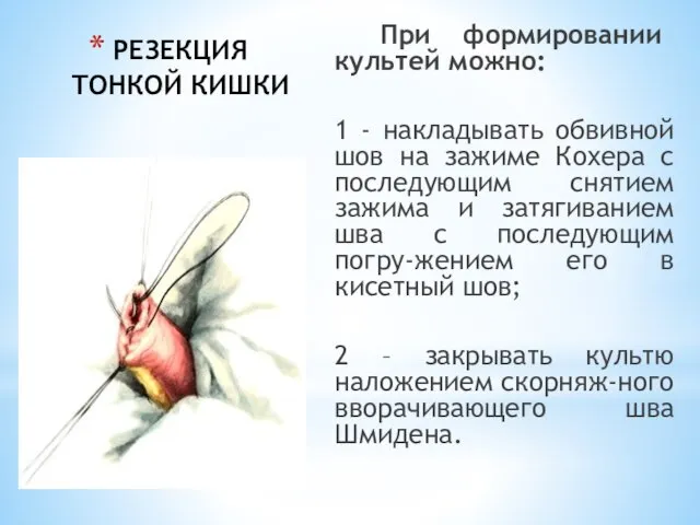 РЕЗЕКЦИЯ ТОНКОЙ КИШКИ При формировании культей можно: 1 - накладывать обвивной шов