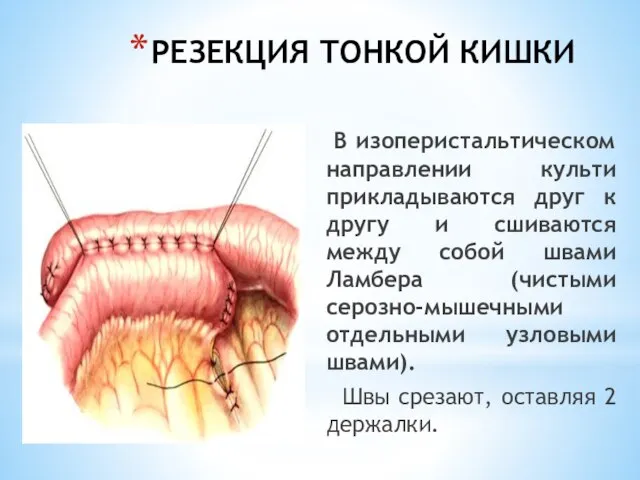 РЕЗЕКЦИЯ ТОНКОЙ КИШКИ В изоперистальтическом направлении культи прикладываются друг к другу и