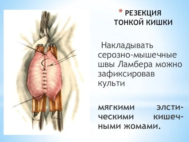 РЕЗЕКЦИЯ ТОНКОЙ КИШКИ Накладывать серозно-мышечные швы Ламбера можно зафиксировав культи мягкими элсти-ческими кишеч-ными жомами.