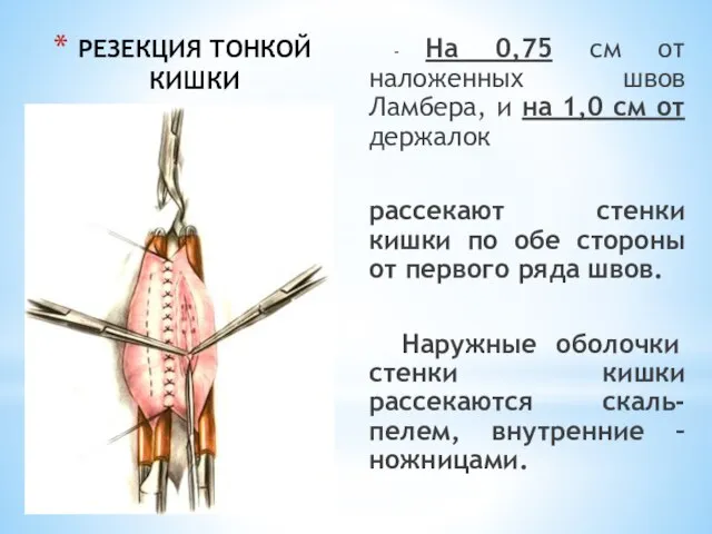 РЕЗЕКЦИЯ ТОНКОЙ КИШКИ - На 0,75 см от наложенных швов Ламбера, и