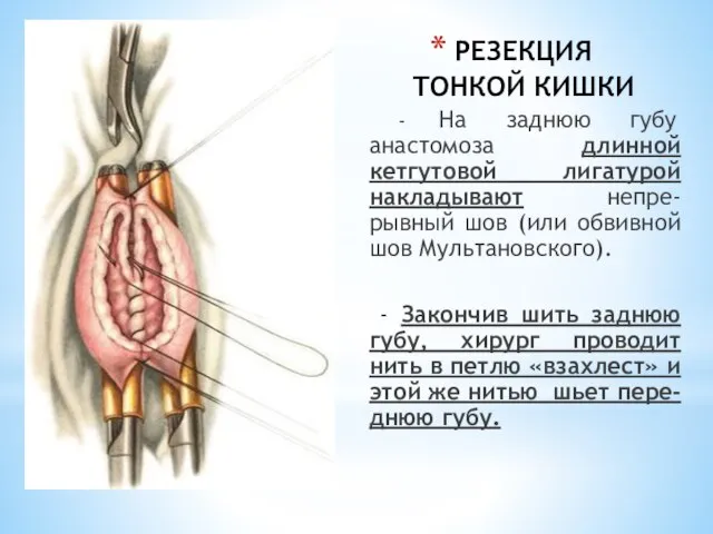 РЕЗЕКЦИЯ ТОНКОЙ КИШКИ - На заднюю губу анастомоза длинной кетгутовой лигатурой накладывают