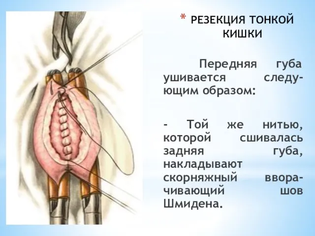 РЕЗЕКЦИЯ ТОНКОЙ КИШКИ Передняя губа ушивается следу-ющим образом: - Той же нитью,