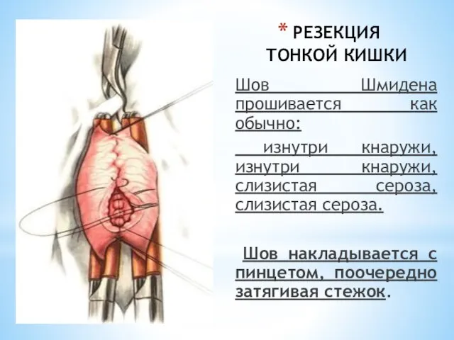 РЕЗЕКЦИЯ ТОНКОЙ КИШКИ Шов Шмидена прошивается как обычно: изнутри кнаружи, изнутри кнаружи,