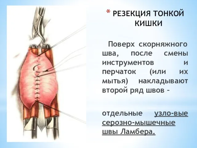 РЕЗЕКЦИЯ ТОНКОЙ КИШКИ Поверх скорняжного шва, после смены инструментов и перчаток (или