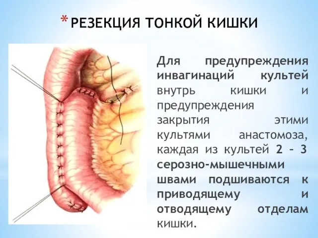 РЕЗЕКЦИЯ ТОНКОЙ КИШКИ Для предупреждения инвагинаций культей внутрь кишки и предупреждения закрытия