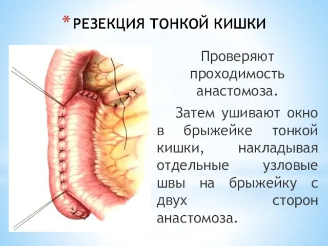 РЕЗЕКЦИЯ ТОНКОЙ КИШКИ Проверяют проходимость анастомоза. Затем ушивают окно в брыжейке тонкой