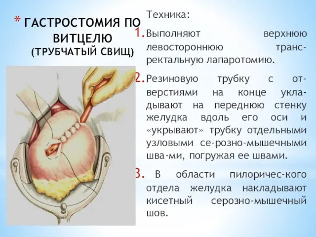 ГАСТРОСТОМИЯ ПО ВИТЦЕЛЮ (ТРУБЧАТЫЙ СВИЩ) Техника: Выполняют верхнюю левостороннюю транс-ректальную лапаротомию. Резиновую