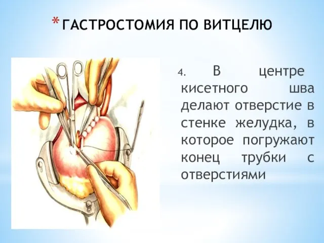 ГАСТРОСТОМИЯ ПО ВИТЦЕЛЮ 4. В центре кисетного шва делают отверстие в стенке