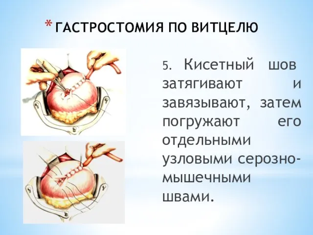 ГАСТРОСТОМИЯ ПО ВИТЦЕЛЮ 5. Кисетный шов затягивают и завязывают, затем погружают его отдельными узловыми серозно-мышечными швами.