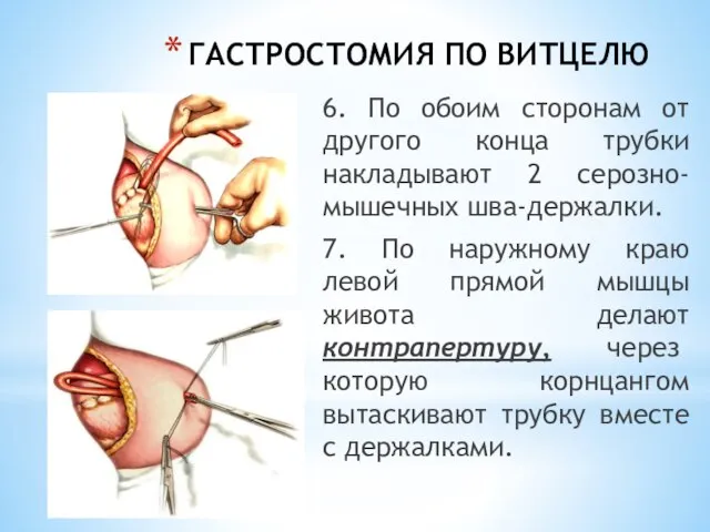 ГАСТРОСТОМИЯ ПО ВИТЦЕЛЮ 6. По обоим сторонам от другого конца трубки накладывают