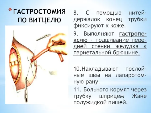 ГАСТРОСТОМИЯ ПО ВИТЦЕЛЮ 8. С помощью нитей-держалок конец трубки фиксируют к коже.